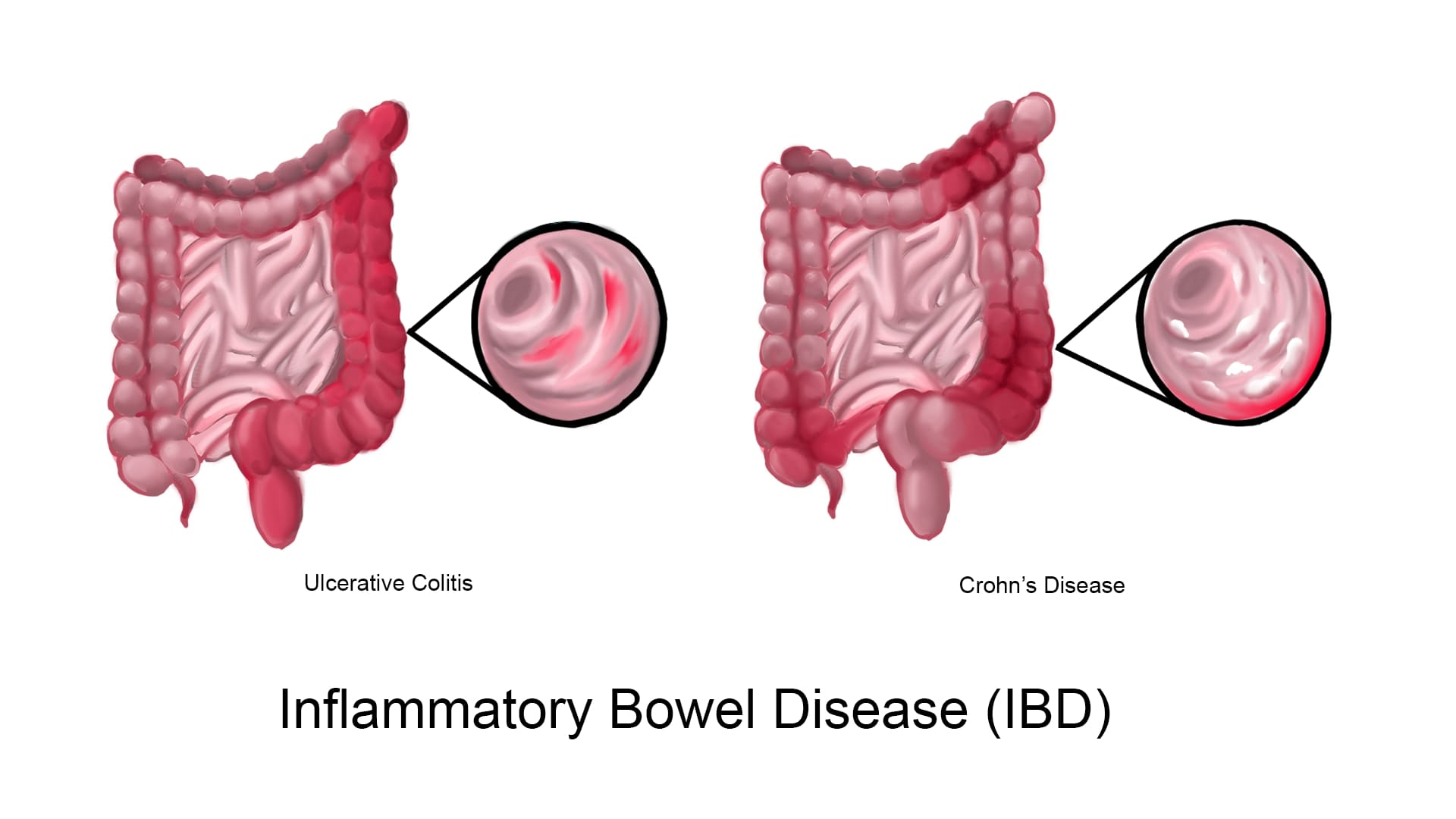 Inflammatory Bowel Disease (IBD): An Overview - MindxMaster